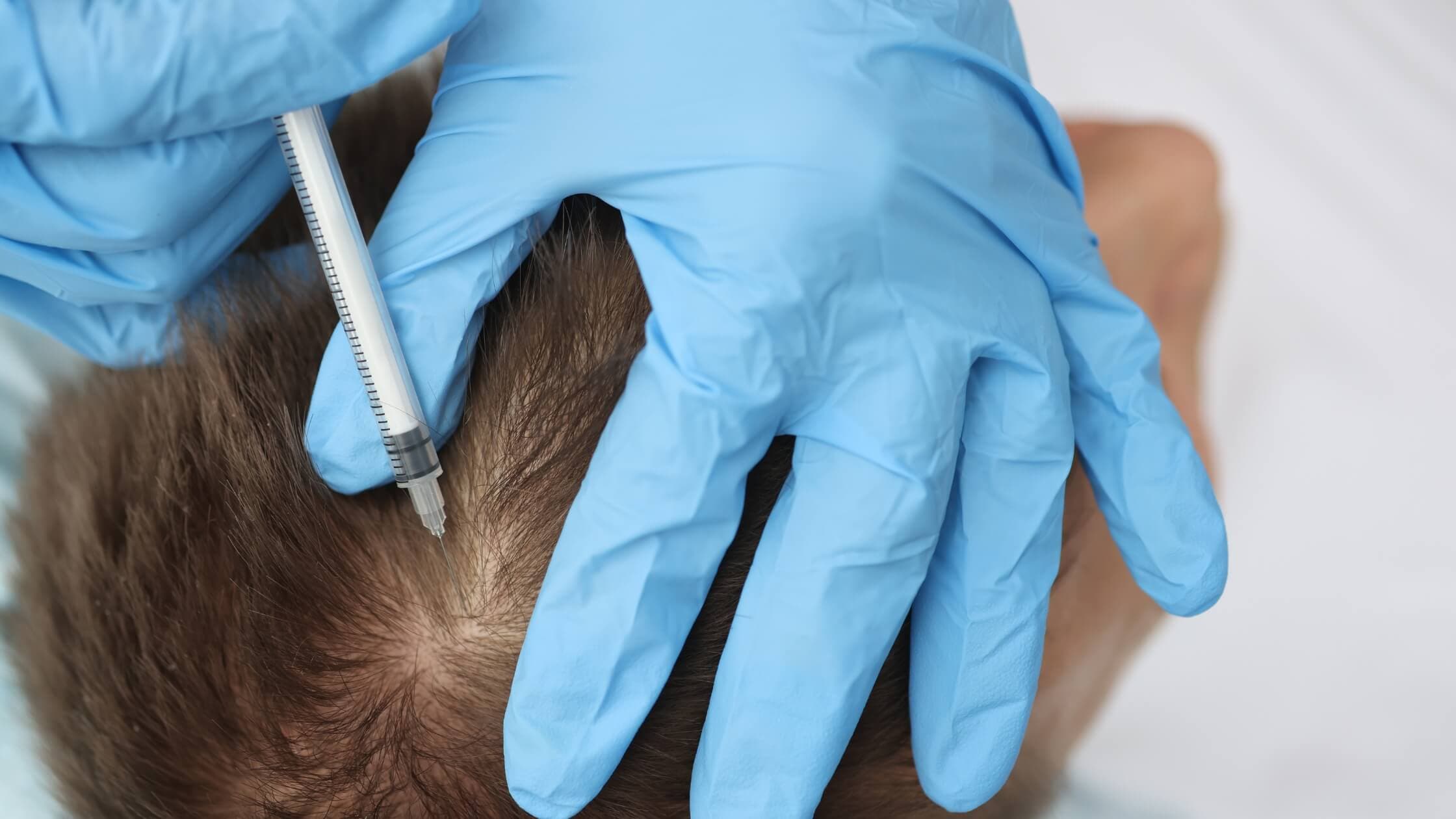 PRP Therapy for Skin and Hair Rejuvenation