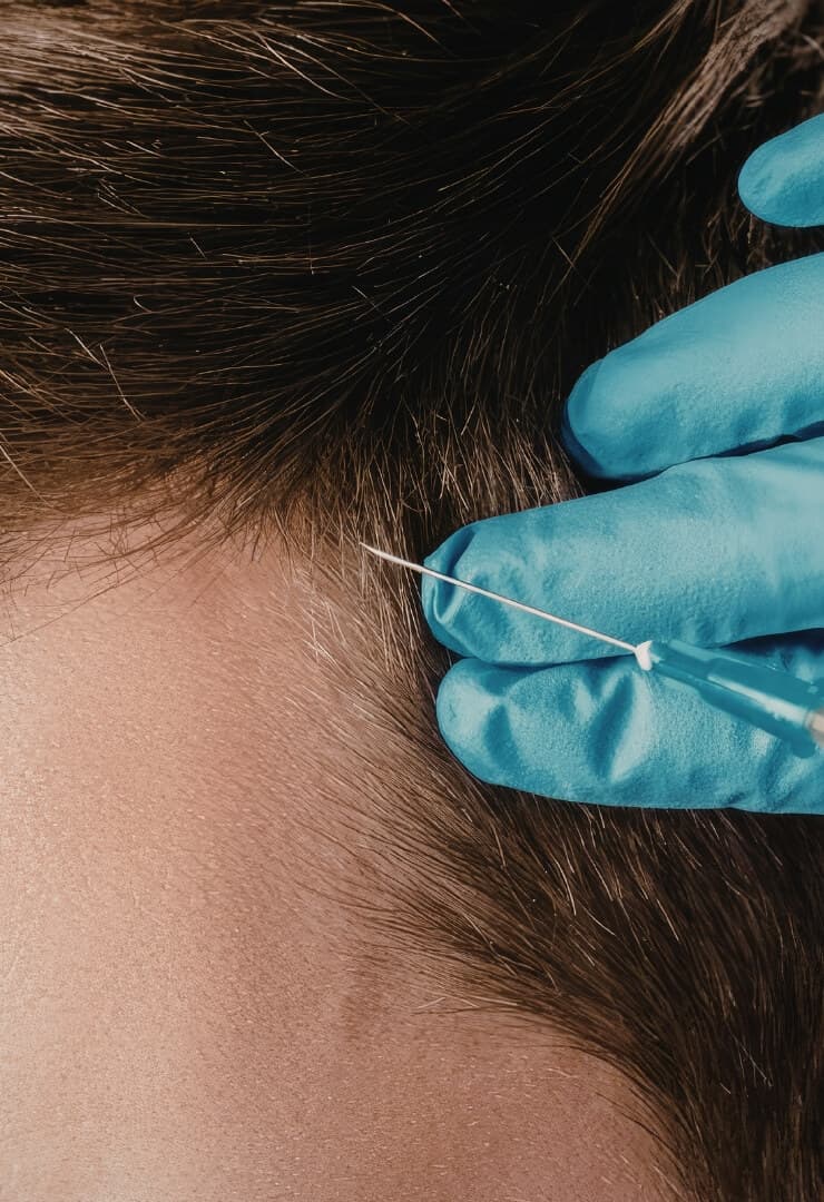 PRP therapy for hair restoration