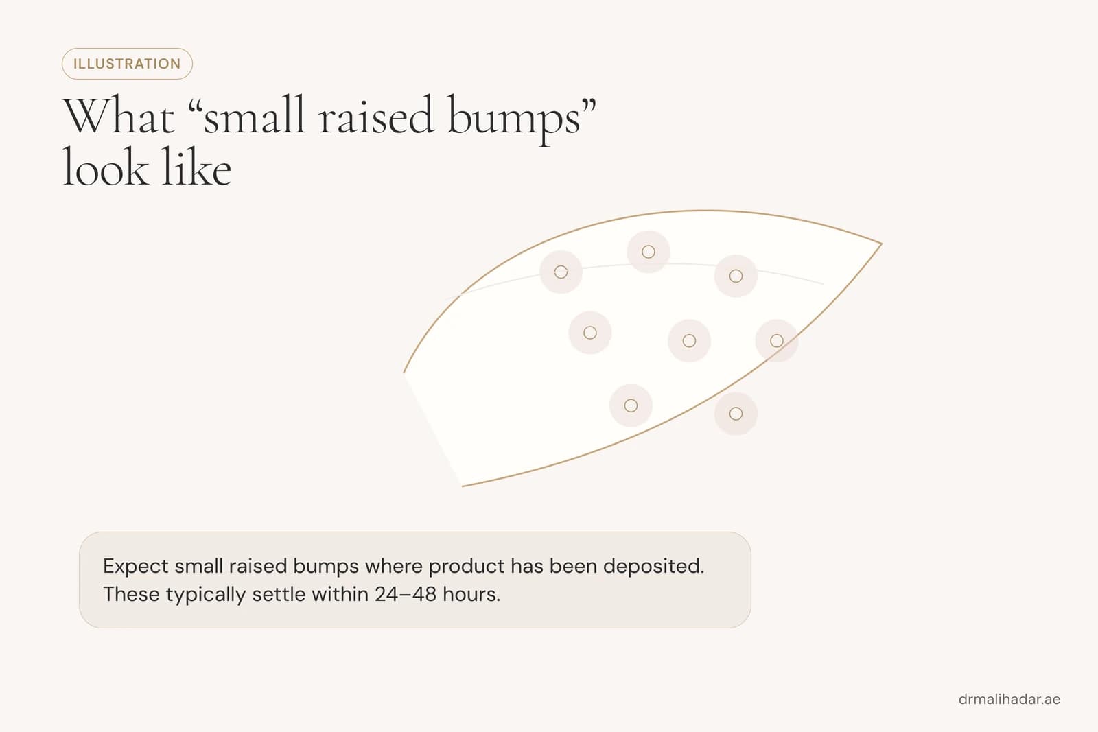 Illustration of small raised bumps at the injection points on a cheek immediately after a Rejuran session